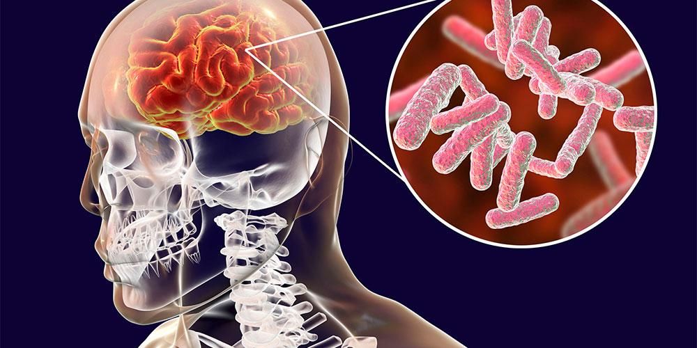 TB aivokalvontulehdus, kun bakteerit tartuttavat aivojen kalvoja