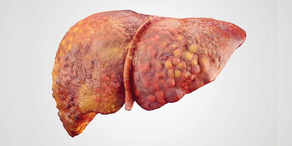 Propuknutí pacitanové hepatitidy A, rozpoznat příznaky a způsoby přenosu této nemoci