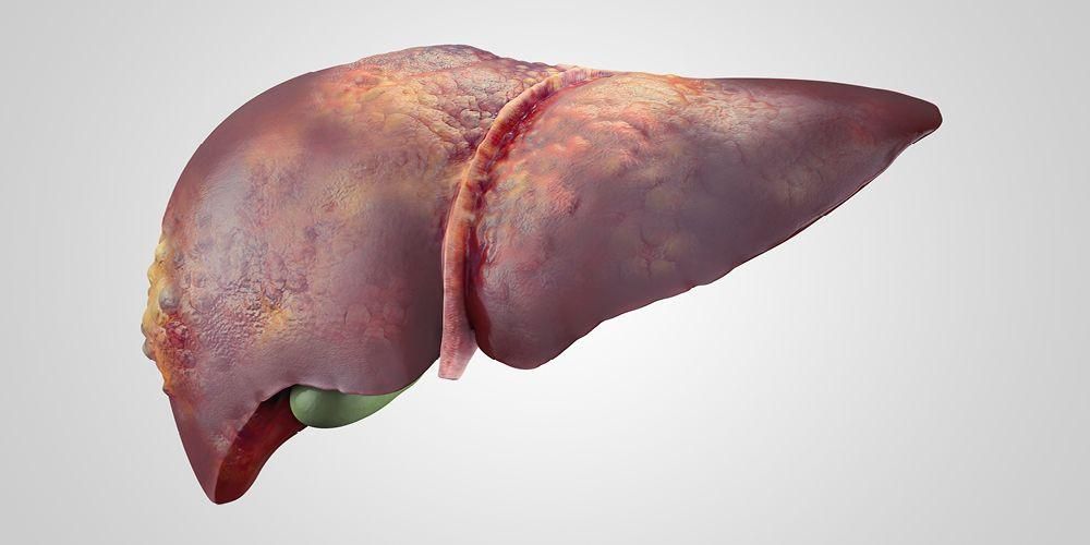 Poznajte faze bolezni jeter, dokler ne povzročijo odpovedi jeter