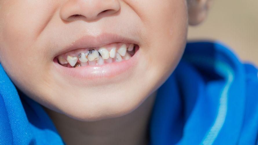 Melni zobi bērniem, atpazīst cēloni un kā to pārvarēt