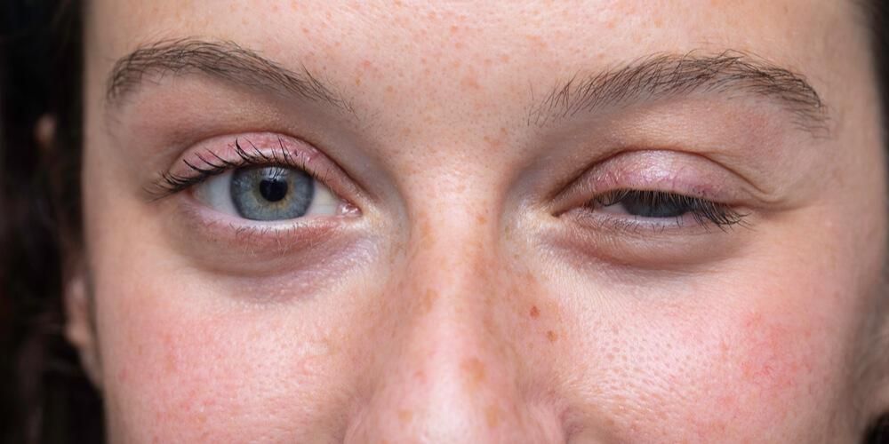 Hengende øyelokk Symptomer på Myasthenia Gravis, finnes det en kur?
