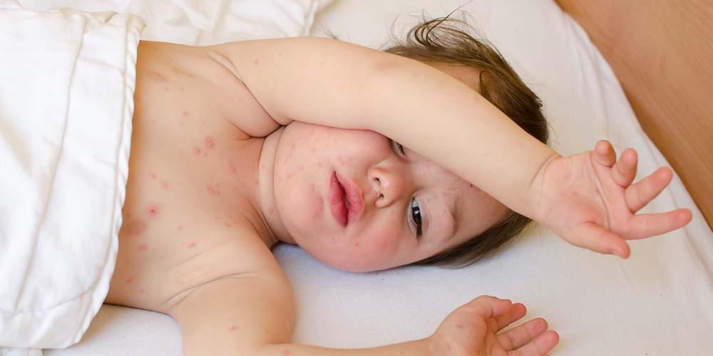 Roseola Infantum, ochorenie, ktoré je náchylné napadnúť vaše dieťa