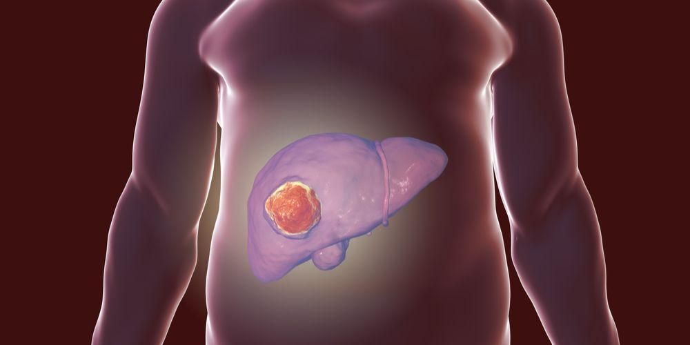 Razumevanje tumorjev jeter, ki so lahko benigni, lahko pa tudi rak