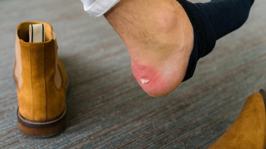 5 måter å forhindre ripede føtter fra sko
