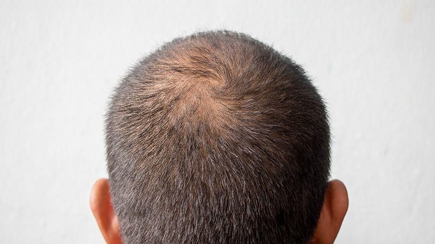 Experimente medicamentos contra a perda de cabelo em farmácias, saiba também os efeitos colaterais
