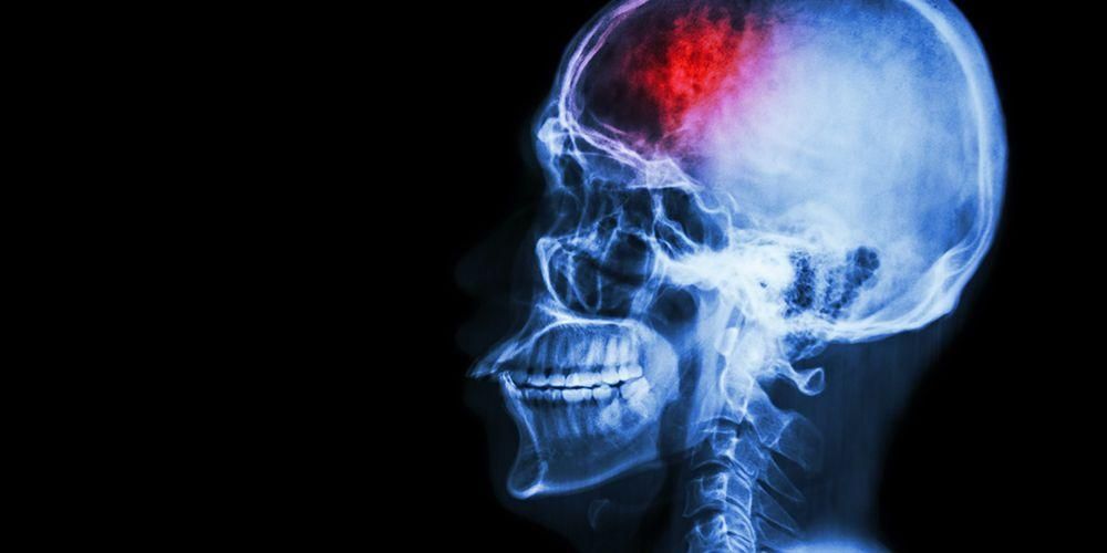 Hjernetraume, hovedskade, der sniger under sport