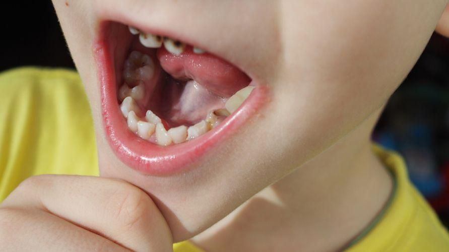 Γνωρίστε την Υπερδοντία, μια πάθηση με υπερβολικό αριθμό δοντιών στο στόμα που μπορεί να επηρεάσει την εμφάνιση