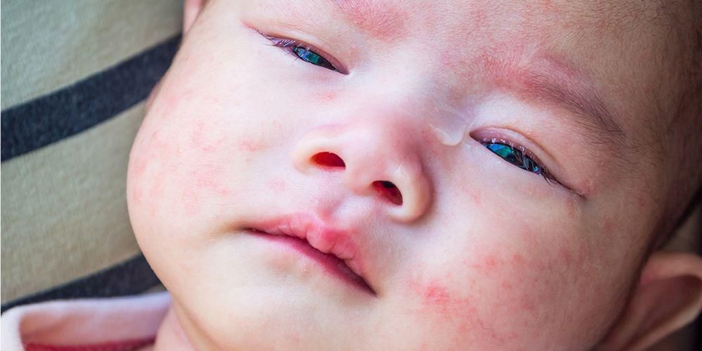 Alergija pienui ir laktozės netoleravimas kūdikiams pasireiškia skirtingai, štai kaip patikrinti!