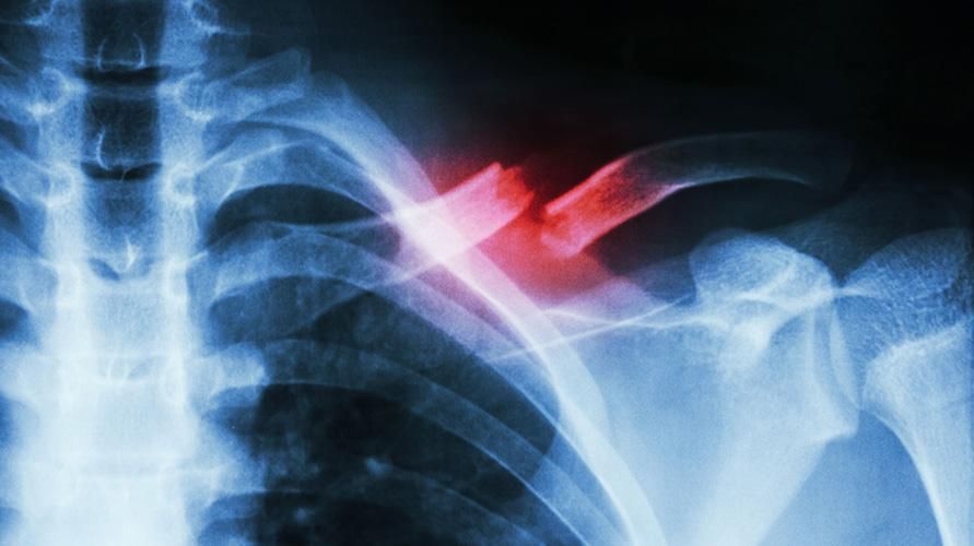 Príčiny zlomeniny kľúčnej kosti a ako ju liečiť