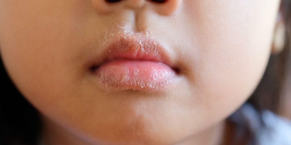 Freqüentemente experimentando lábios rachados? Cuidado com os perigos da dermatite nos lábios
