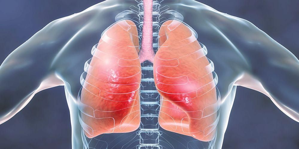 Spoznajte simptome pljučnice, na katere morate biti pozorni