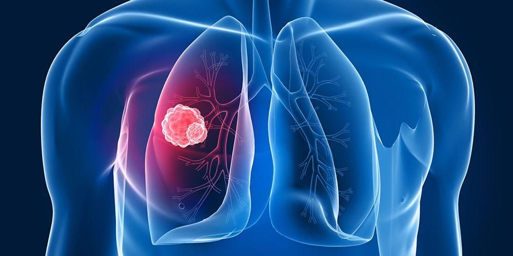 Keuhkokasvaimet eivät aina ole merkki keuhkosyövästä, tässä on selitys
