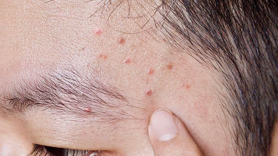 Reconhecer a causa da acne mecânica, com instruções sobre como superá-la