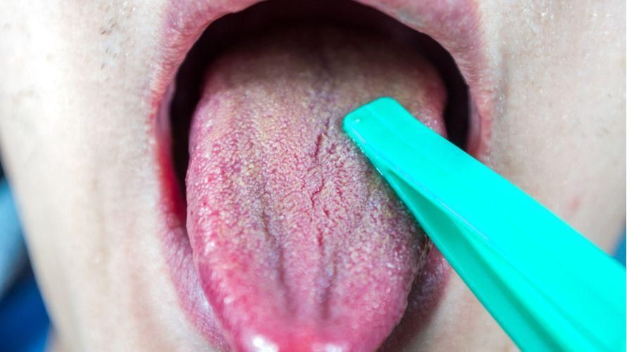 Spoznavanje ustne kandidoze, glivične okužbe, ki se pojavi v ustih