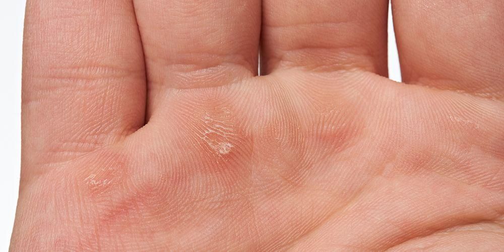 Gjenkjenne årsakene til hard hud på føttene, kan være et tegn på alvorlig sykdom