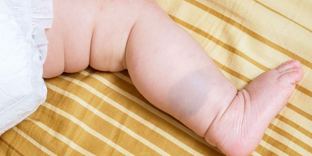 Tipos de marcas de nascença em bebês que os pais precisam saber