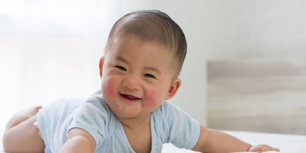 Eczema em bebês causa pânico, saiba como superá-lo