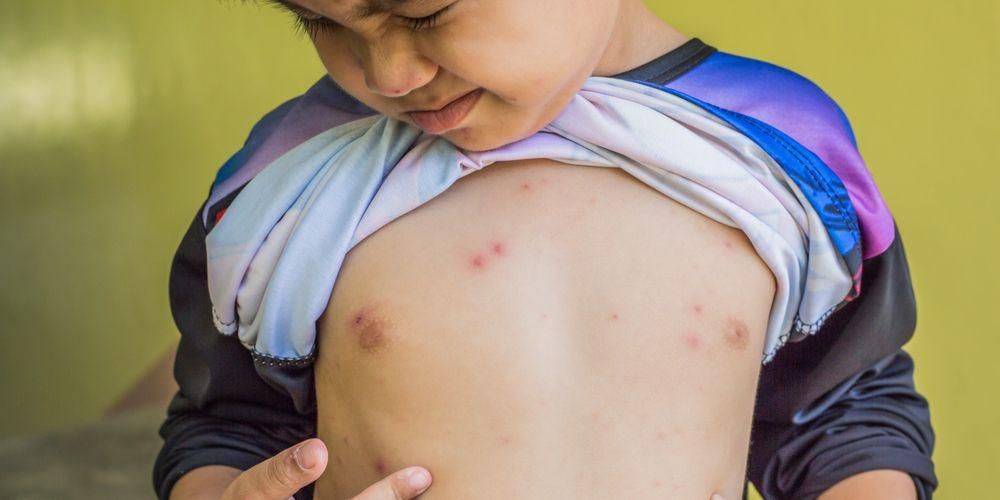 Compreendendo os sintomas e como tratar a varicela em crianças naturalmente