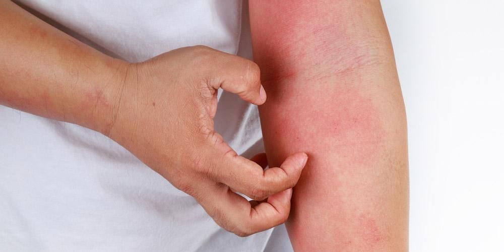Spoznavanje alergijskega kontaktnega dermatitisa, zaradi katerega koža srbi in postane rdeča