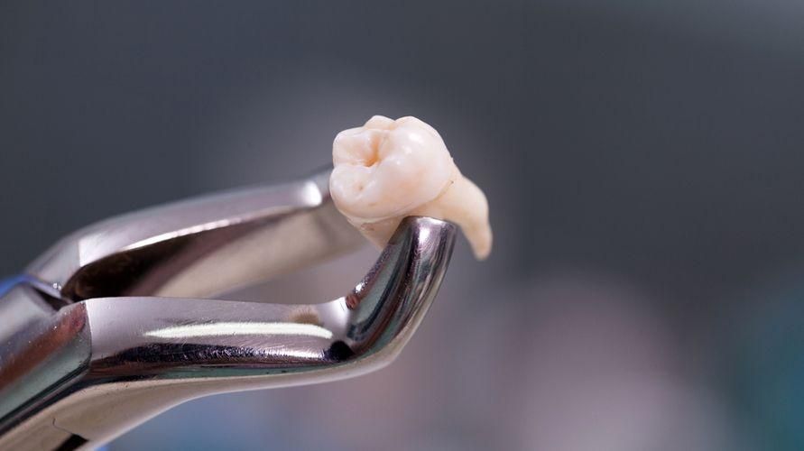 Druhy potravín po extrakcii zubov, ktoré sú bezpečné na konzumáciu a tabu