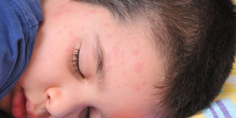 Tämä on ihoreaktio, joka johtuu allergioista kuumalle tai kylmälle ilmalle
