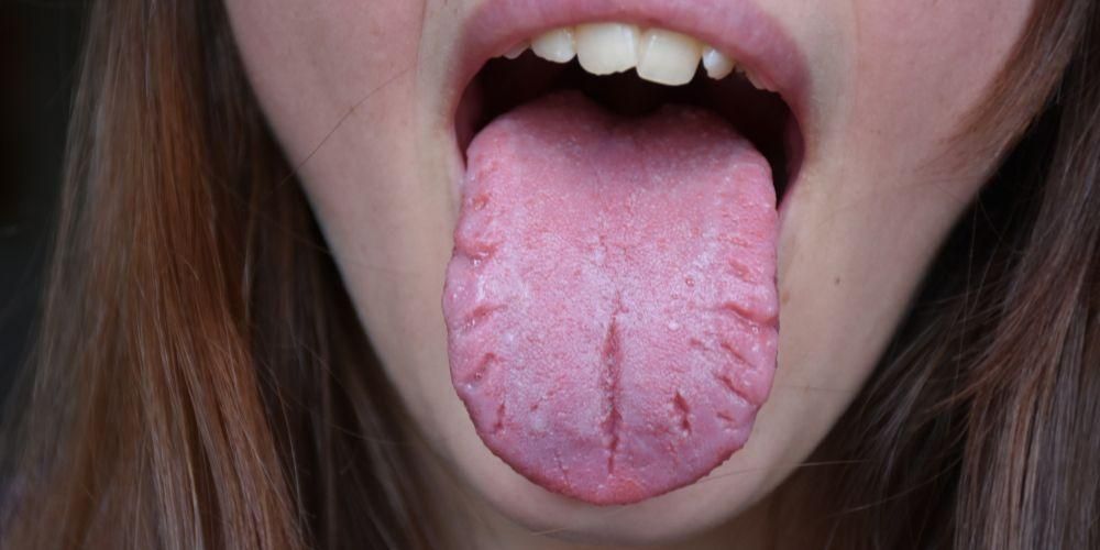 Ikke bli undervurdert, gjenkjenne tilstanden til en sprukken tunge og hvordan du håndterer den
