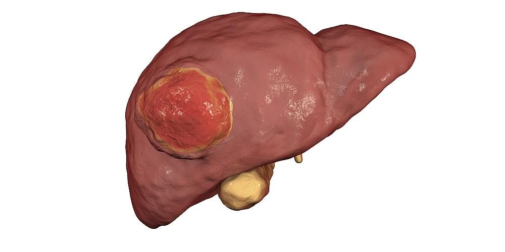 Spoznajte vrste jetrnih tumorjev od benignih do malignih