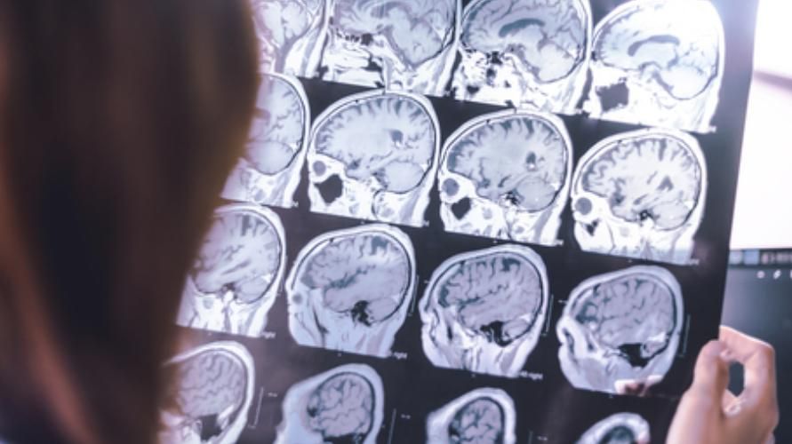Atròfia cerebral, una condició mèdica que pot provocar una contracció del cervell