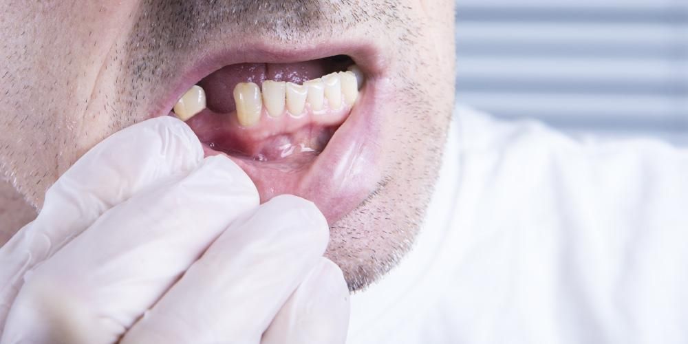 成人牙齿松动的 7 个原因