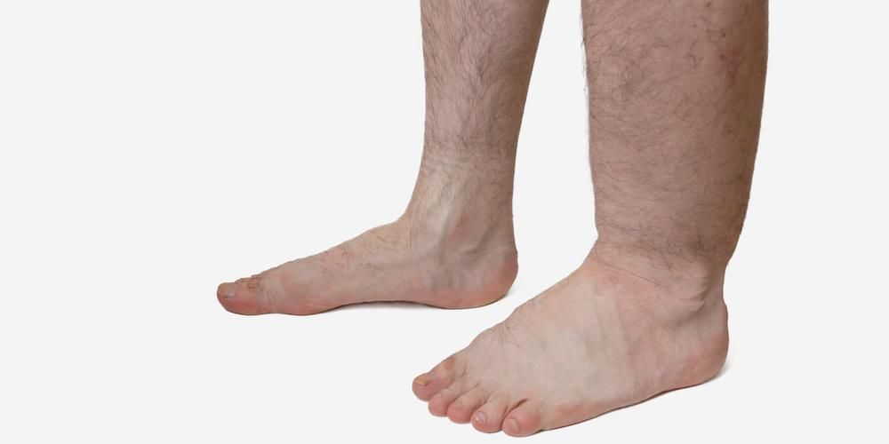 Dramblio pėdos liga: priežastys, ypatybės ir kaip ją gydyti