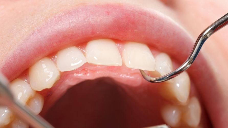 Príčiny poškodenej zubnej skloviny a ako jej predchádzať a ako ju liečiť