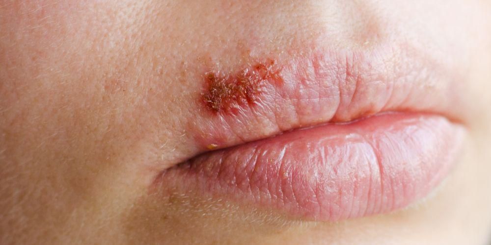 Znáte příznaky kožního herpesu a jak jej účinně léčit