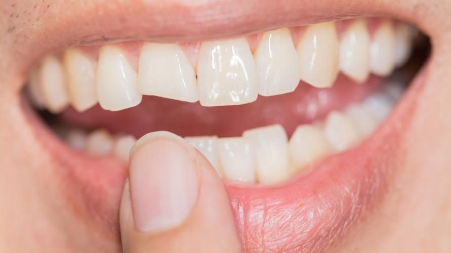 پھٹے دانتوں کی وجوہات اور اس پر قابو پانے کے اختیارات