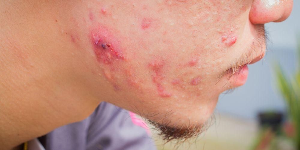 Ito ang pagkakaiba sa pagitan ng cystic acne at ordinaryong acne