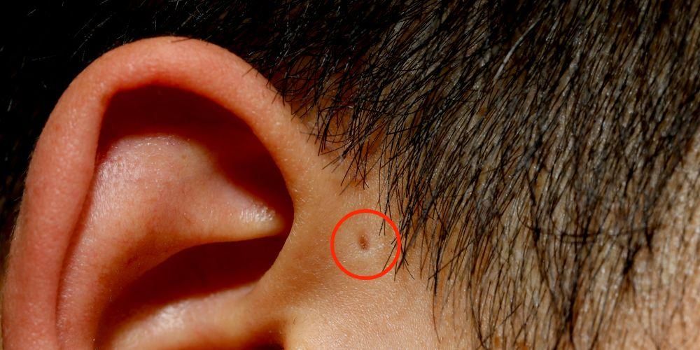 Мала рупа у уху или преаурикуларна јама, безопасна урођена