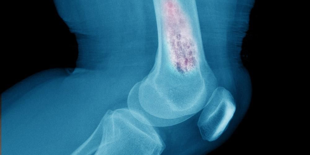 Често занемарени, ово су симптоми рака костију на које треба обратити пажњу