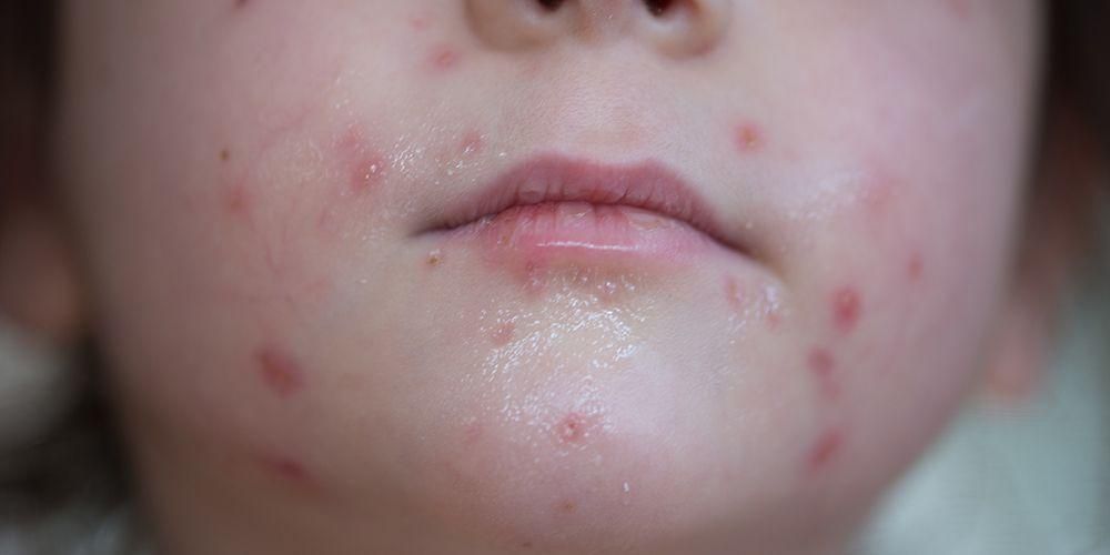3 bolezni, ki jih povzroča ta virus, lahko napadejo vašo kožo