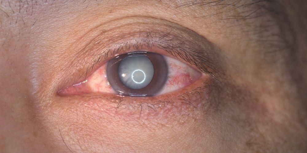 7 tipus de defectes oculars que hauríeu de tenir en compte