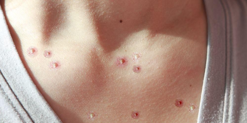 La varicel·la en adults pot ser més perillosa, aquí teniu el perquè