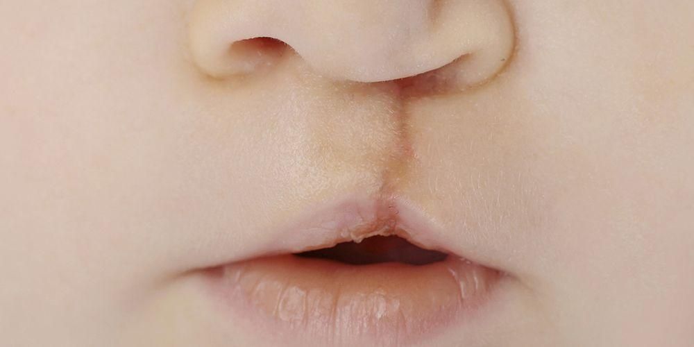 Lábio leporino em bebês, pode ser detectado no útero
