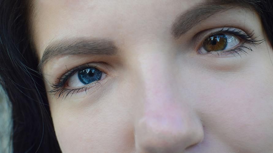 Heterokromi har en annen øyefarge, kan være medfødt eller på grunn av traumer