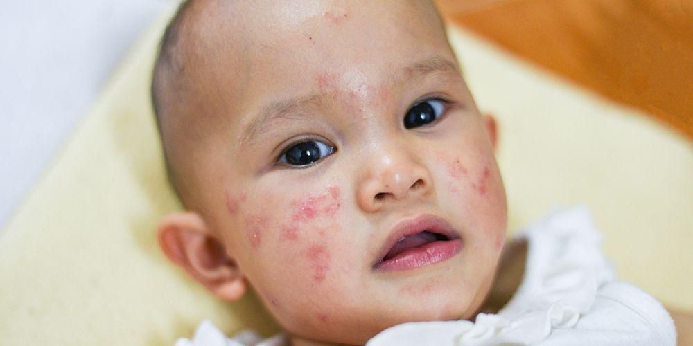L'acne als nadons, és perillós?