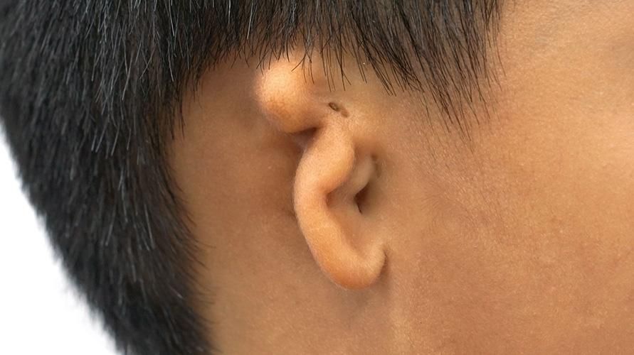 Microtia là một dị tật bẩm sinh gây mất thính giác ở trẻ sơ sinh