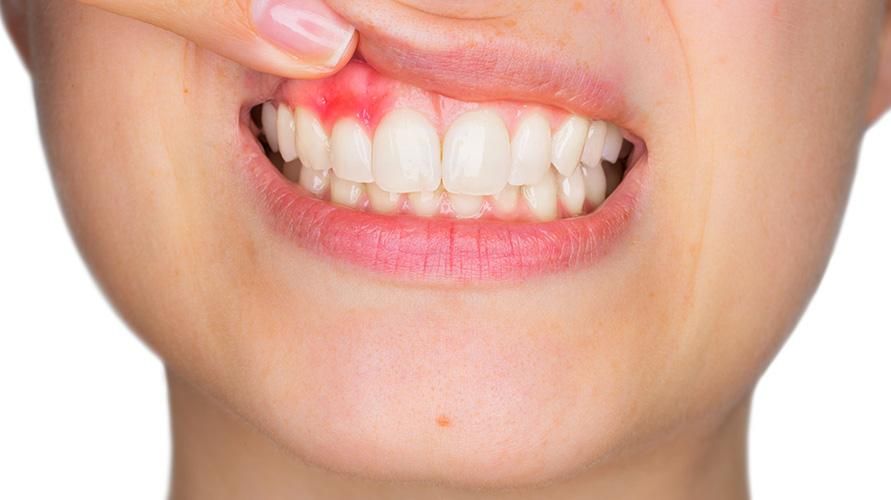 7 årsager til kløende tandkød, hvordan man overvinder det?