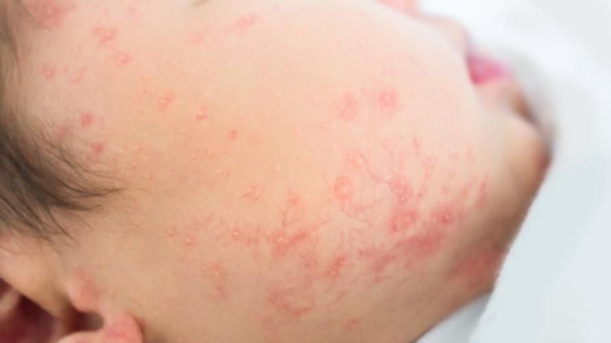 بچوں میں الرجی کے ٹیسٹ کے 6 طریقے جو ڈاکٹر تجویز کر سکتے ہیں۔