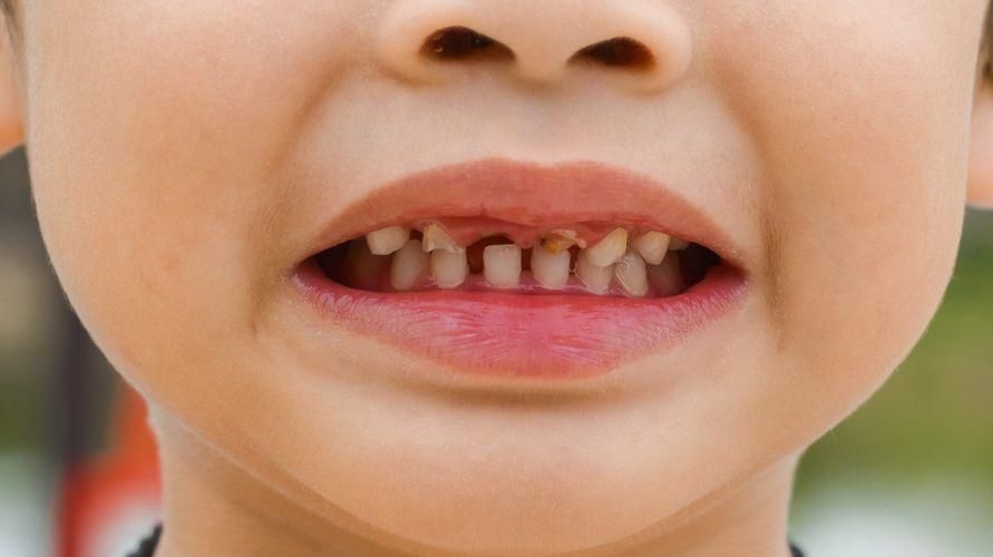 Bērnu zobu dobuma cēloņi un to pareiza ārstēšana
