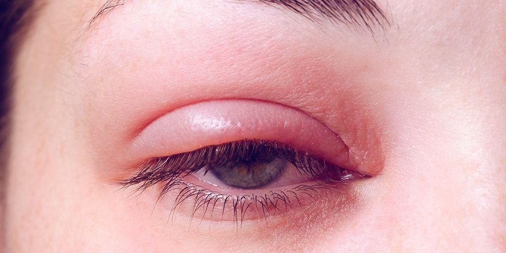 5 odos problemos, kurių simptomai gali sukelti akių vokų patinimą, skausmą ir niežėjimą