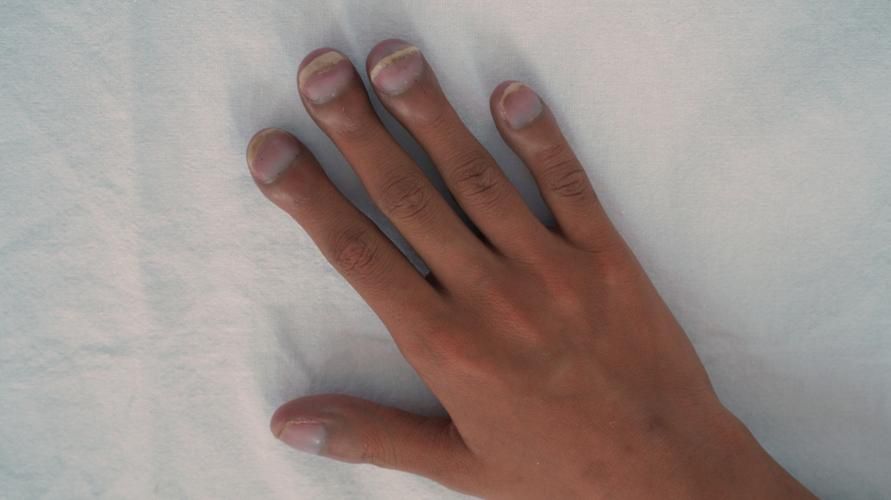 Causes de les escombraries dels dits o de les ungles i com superar-les correctament