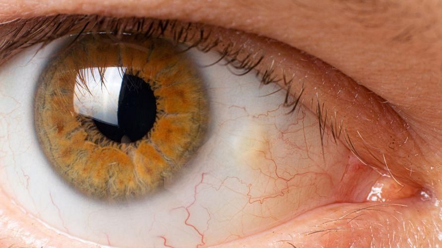 Nguyên nhân của đốm vàng trên mắt và cách thoát khỏi nó