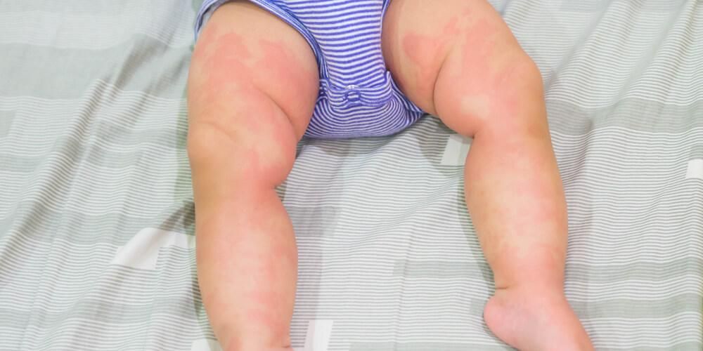 当婴儿出现荨麻疹时，正确的处理方法是什么？